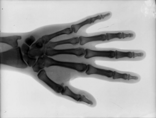 Close-up view of an x-ray that shows a hand.